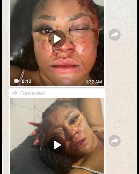 First photos of Angela Okorie emerge as 14 pellets of bullet were allegedly removed from her hair