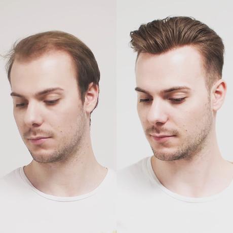 Non-surgical vs. surgical hair replacement: Which is best?