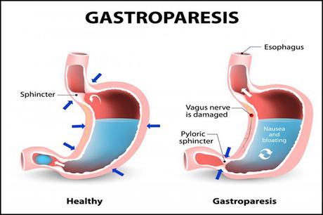 Gastroparesis and it’s Natural Treatment