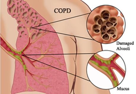 Chronic Obstructive Pulmonary Disease (COPD) Treatment in Ayurveda