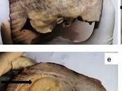 Ayurvedic Treatment Endometrial Stromal Sarcoma