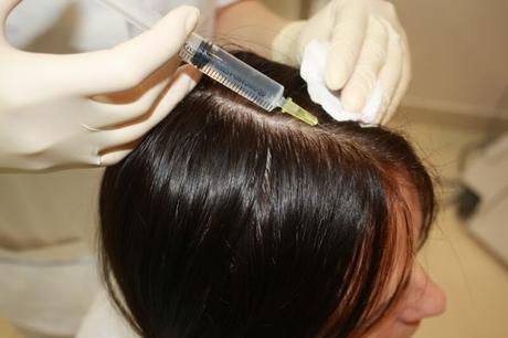 Mesotherapy: Procedure, Side Effects, and Benefits