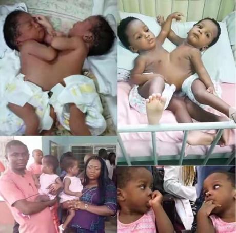 Nigerian Hospital Announces First Successful Separation Of Conjoined Twins After 16 Months Surgery
