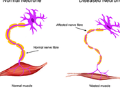 Motor Neurone Disease Treatment Ayurveda