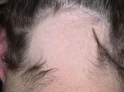 Alopecia Areata: Symptoms, Causes, Diagnosis, Treatment