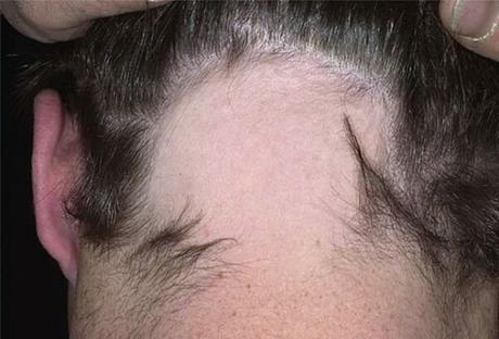 Alopecia Areata Condition