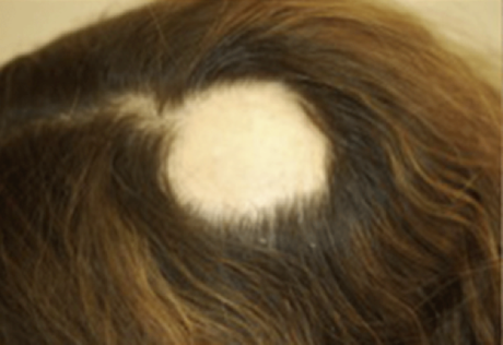 Alopecia Areata Symptoms