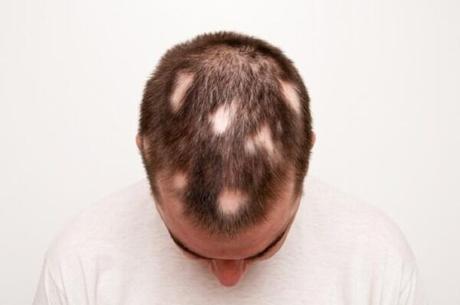 Alopecia Areata: Symptoms, Causes, Diagnosis, And Treatment