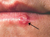 Natural Treatment Herpes Simplex Virus Infection (Herpes)