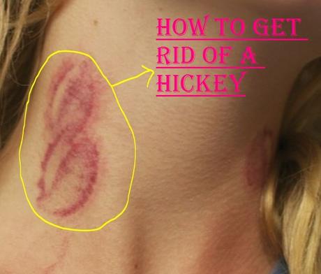 How to get rid of a hickey How to get rid of a hickey