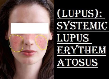 SLE(Lupus) systemic lupus erythematosus