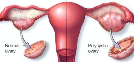 Let’s Talk About PCOS: Causes, Symptoms, And Treatment