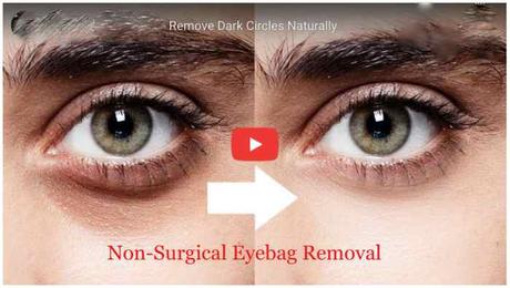 Eye Bag Removal : How To Remove Eye Bags Permanently Shocking!