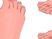 Bent Crooked Toes: Tips Treatment Prevention