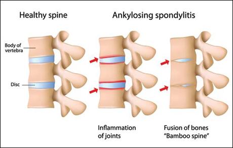 Natural Treatment of Ankylosing Spondylitis (AS)