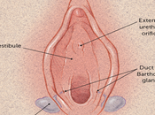 Herbal Remedies Bartholin’s Cyst