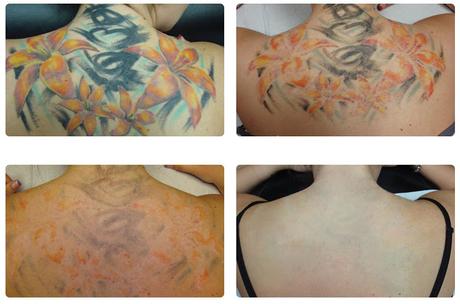 The Complete Beginner’s Guide to Laser Tattoo Removal