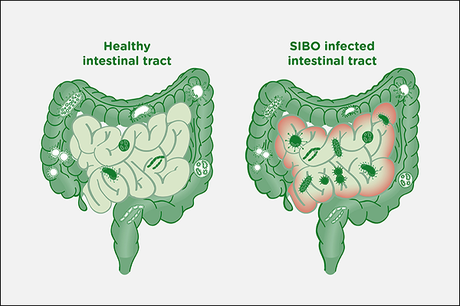 Treatment of Small Intestinal Bacterial Overgrowth (SIBO) through Ayurveda
