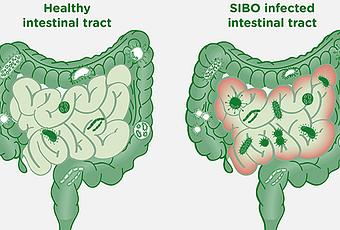 small intestinal bacterial overgrowth symptoms