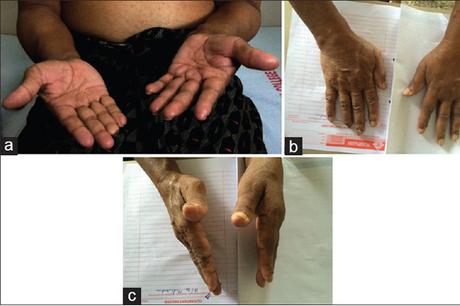 Alternative Ayurvedic Treatment for CIDP