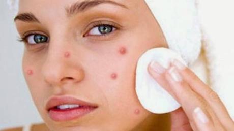 What are Acne? What is the Ayurvedic Treatment for Removal of Acne?