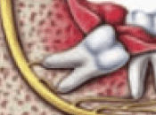 Wisdom Teeth Removal Procedure