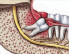 Wisdom Teeth Removal Procedure wisdom-tooth-removal