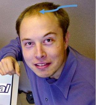 Elon Musk Hair Loss and Recovery Story [Transformation]