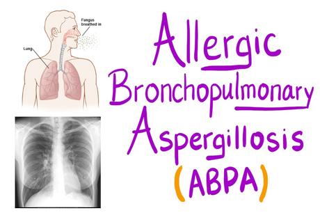 Alternative Treatment for Allergic Bronchopulmonary Aspergillosis (ABPA)