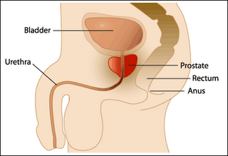 HIFU and Prostate Cancer