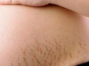 Trusted Tips Treatment Stretch Marks Removal