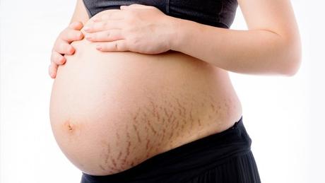 Trusted Tips and Treatment for Stretch Marks Removal