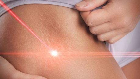 Trusted Tips and Treatment for Stretch Marks Removal