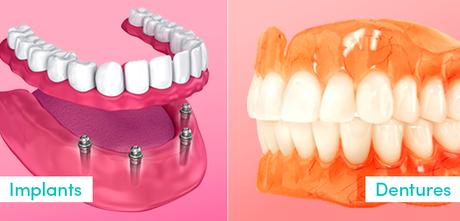 What is Right for You between Dental Implants and Dentures?