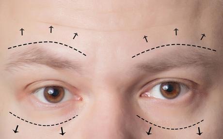 What You Should Know About Blepharoplasty in Singapore