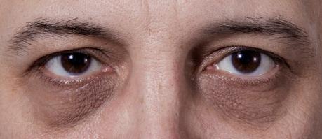 What You Need to Know about Eye Bag Removal Singapore