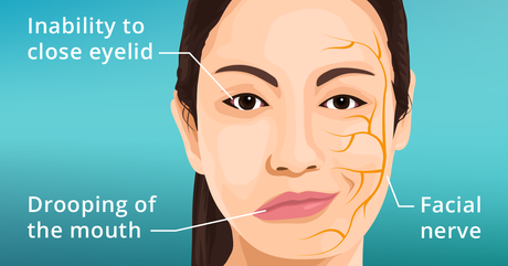 Bell’s Palsy and Its Ayurvedic Treatment