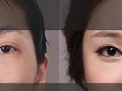 Double Eyelid Surgery Singapore: What Need Know