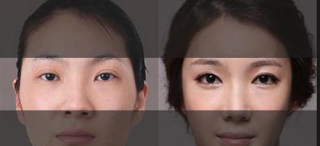 Double Eyelid Surgery in Singapore: What you need to know