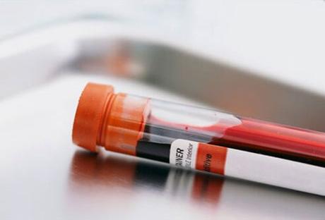 Type 2 Diabetes latest #Type2Diabetes Photo of a blood sample that is used to diagnose type 2 diabetes.