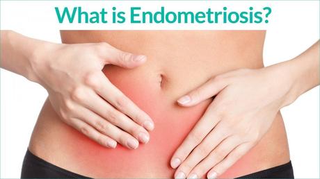 Ayurvedic Treatment For Endometriosis