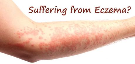 Ayurvedic Treatment for Eczema