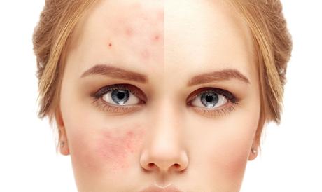 How we can get Rid of Acne with the help of an Acne Go Kit of CAC?