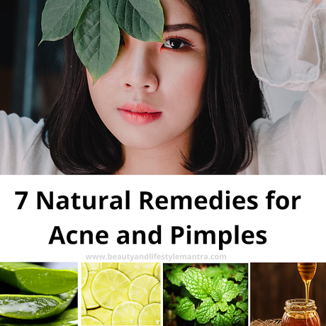 7 Natural Remedies for Acne and Pimples
