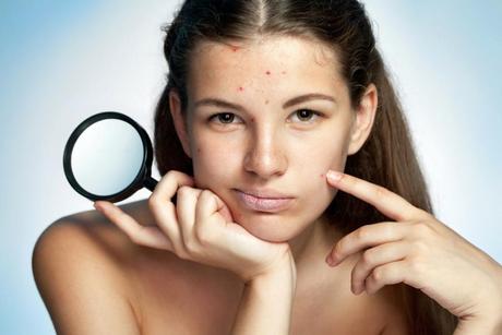 Blackheads