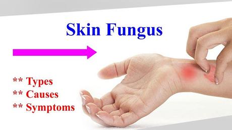 How to Treat Fungal Infection through Ayurveda?