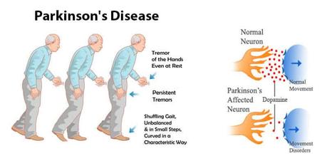 Parkinson’s  Disease