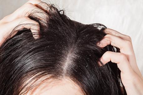 Best Dry Scalp and Head Care Solutions