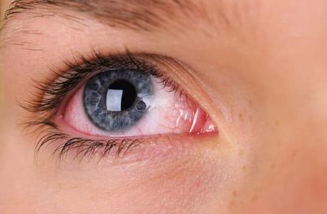 How to treat Conjunctivitis in Ayurveda?