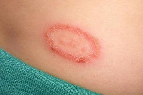 What is Ringworm? How to treat Ringworm by Natural Medicines What is Ringworm? How to treat Ringworm by Natural Medicines